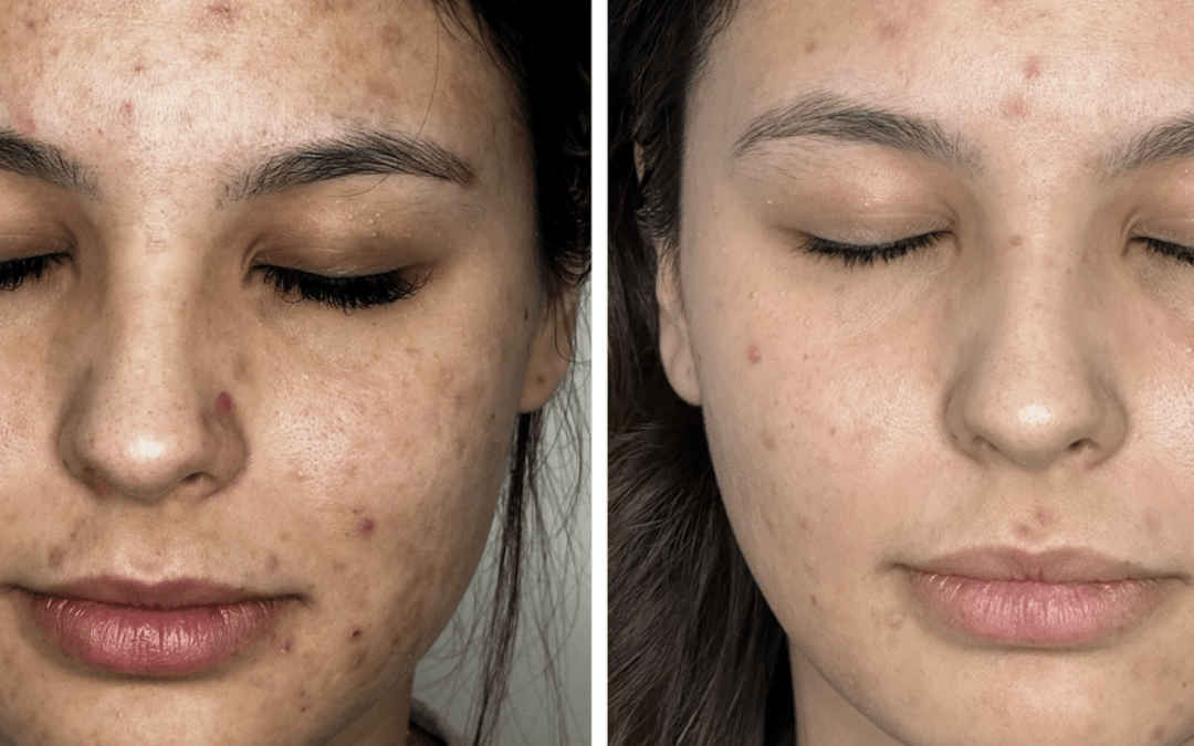 PCOS Beard Treatment Result