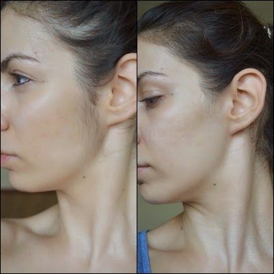 Upper Lip Treatment Result