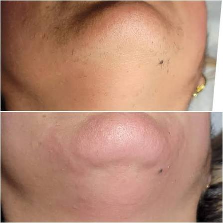 Eyebrows Treatment Result