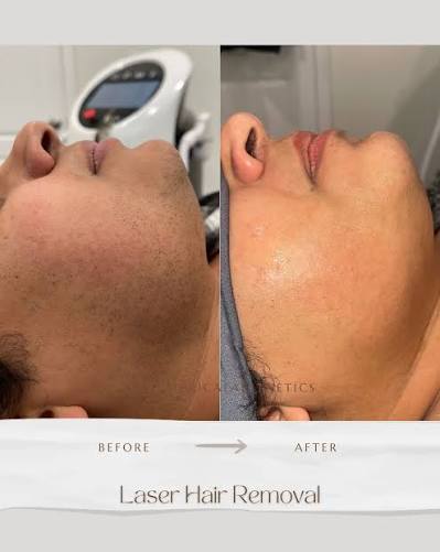 Underarms Treatment Result